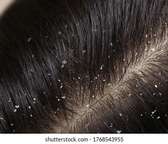 dandruff