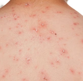 chickenpox
