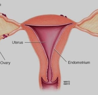 ENDOMETRIOSIS