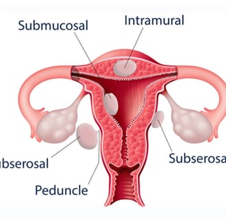 Uterine fibroids