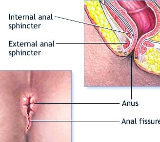 A fissures