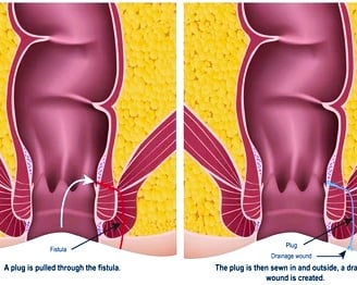 Anal Fistula