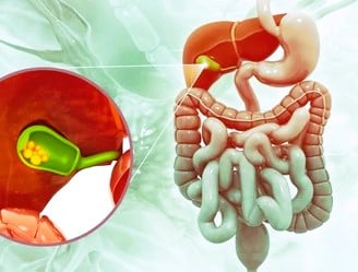 gallstones