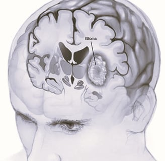 Glioma