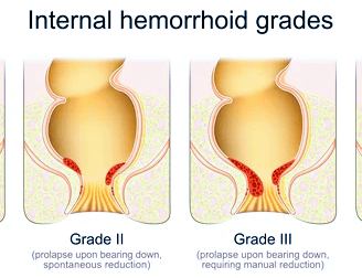 Hemorrhoids