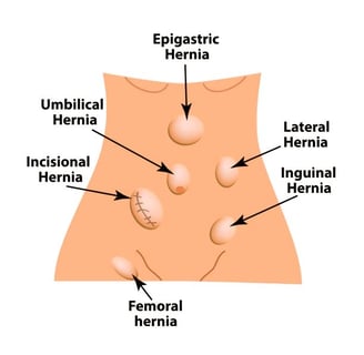 Hernias