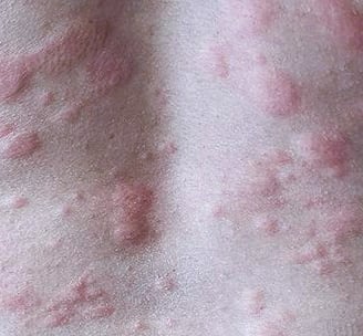 Hives