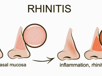 rhinitis