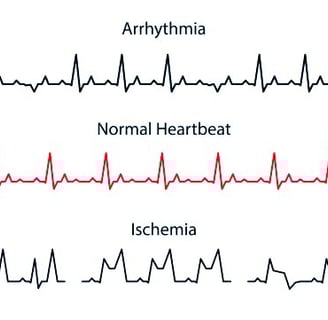 Irregular Heartbeats