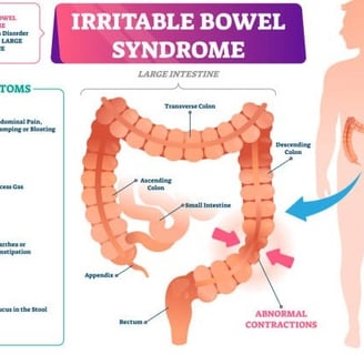 irritable bowel syndrome