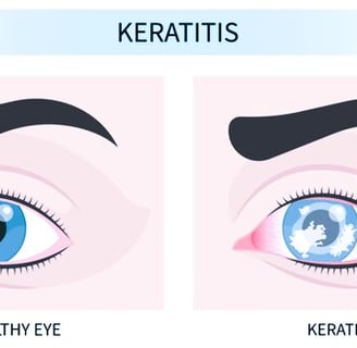 keratitis