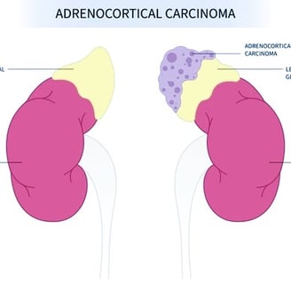 adrenocortical carcinoma