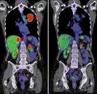 Liver Cancer