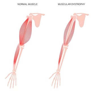 Muscular dystrophy