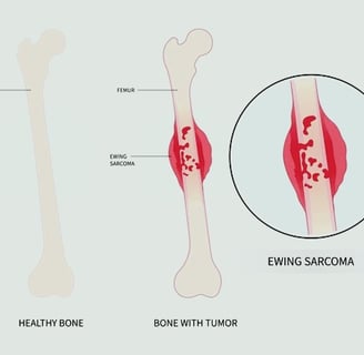Bone Cancer