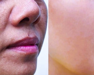 melasma