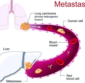 Metastatic Cancer