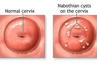 nabothian cysts