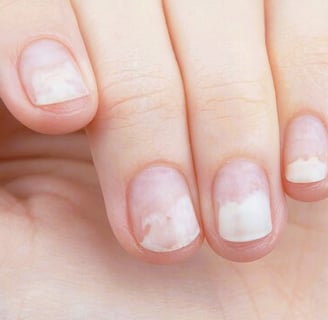 onycholysis
