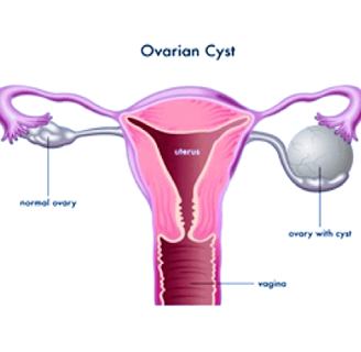 ovarian cysts