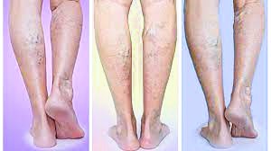 peripheral artery disease(pad)