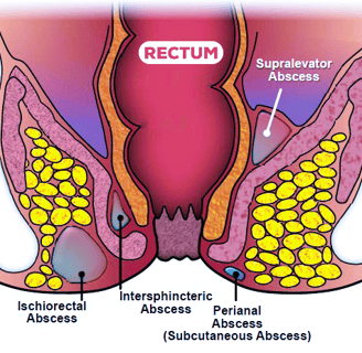 Perianal Abscesses