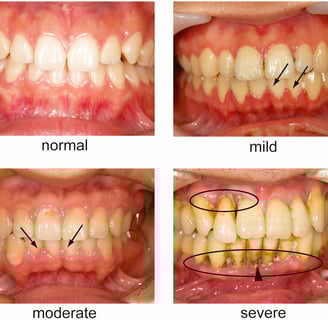 periodontal