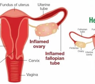 Pelvic Inflammatory Disease (PID)