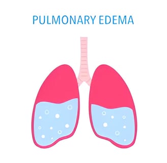 Pulmonary edema