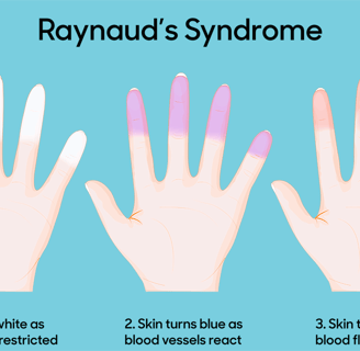 ray-syndrome