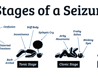 Epilepsy and Seizures