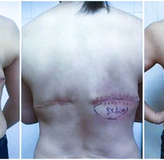 seroma
