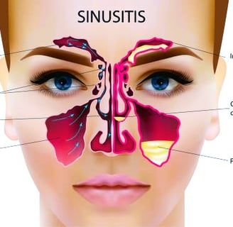 Sinusitis image