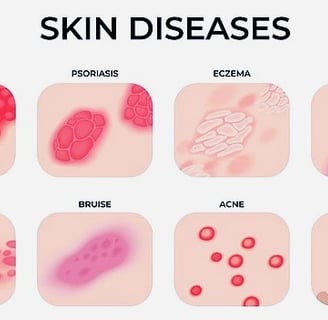 skin diseases