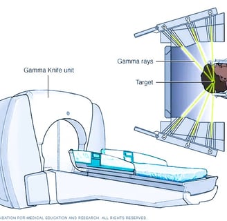 stereotactic radiosurgery