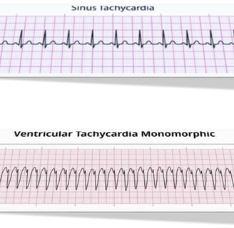 tachycardia 
