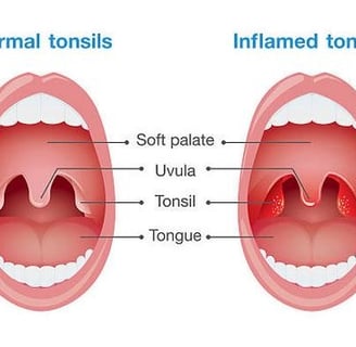 tonsils