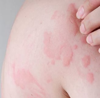 urticaria