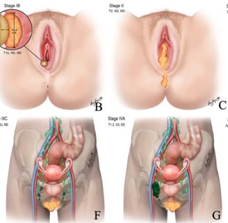 vulvar cancer