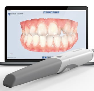 Scanner intraoral moderno oferecendo precisão e conforto superiores