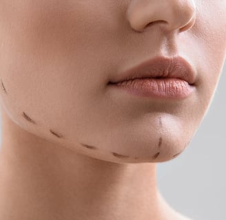 Close-up of a chin with surgical markings for a cosmetic procedure.