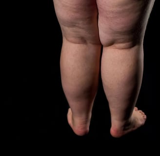 lipedema