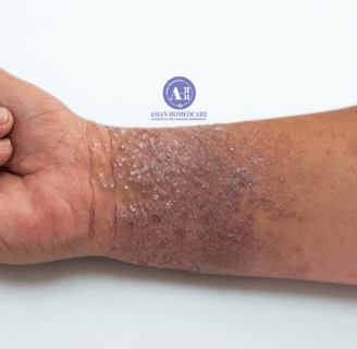 Atopic dermatitis (Eczema) Homeopathic treatment