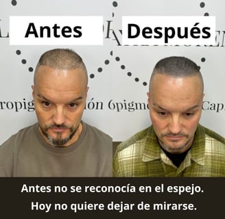 Redensificación con micropigmentación capilar tras injerto en hombre – Madrid