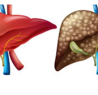 _Beware of the inevitable fate of fatty liver,fibrosis , cirrhosis, esophageal varices and hepatoma