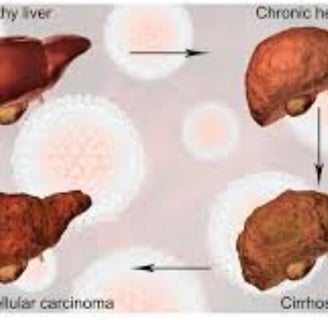 fatty liver,fibrosis , cirrhosis, esophageal varices and hepatoma