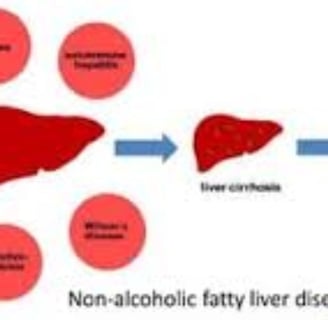 cirrhosis, esophageal varices and hepatoma