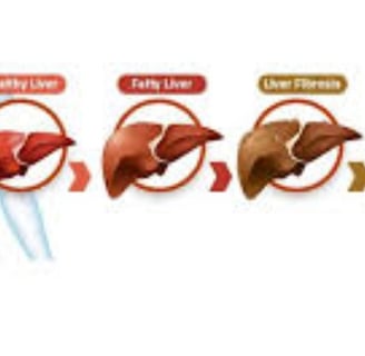 _Beware of the inevitable fate of fatty liver,fibrosis , cirrhosis, esophageal varices and hepatoma