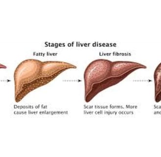 _Beware of the inevitable fate of fatty liver,fibrosis , cirrhosis, esophageal varices and hepatoma