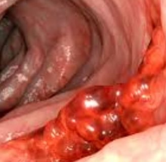 _bleeding from anus with pain